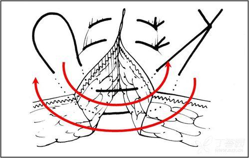 外翻缝合视频,视频教程深度解读