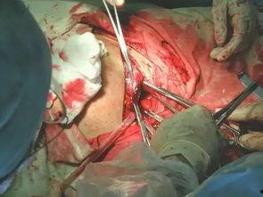 分娩手术视频,直观呈现母婴安全守护瞬间